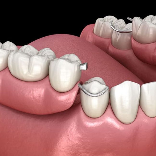 partial-dentures-16