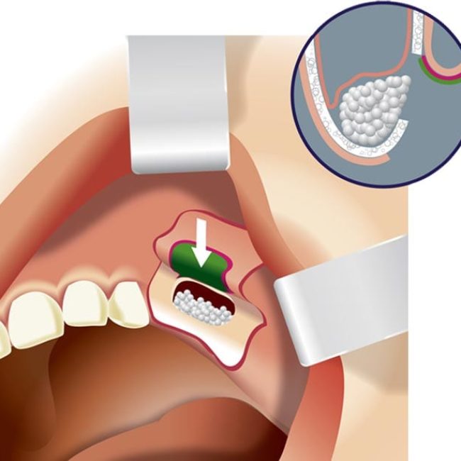 sinus-lifting-and-bone-grafting